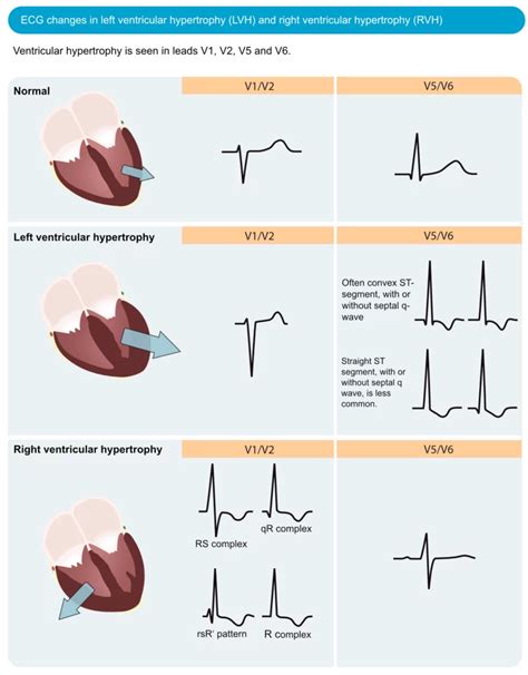 niet gedilateerde lv|Left ventricular hypertrophy .